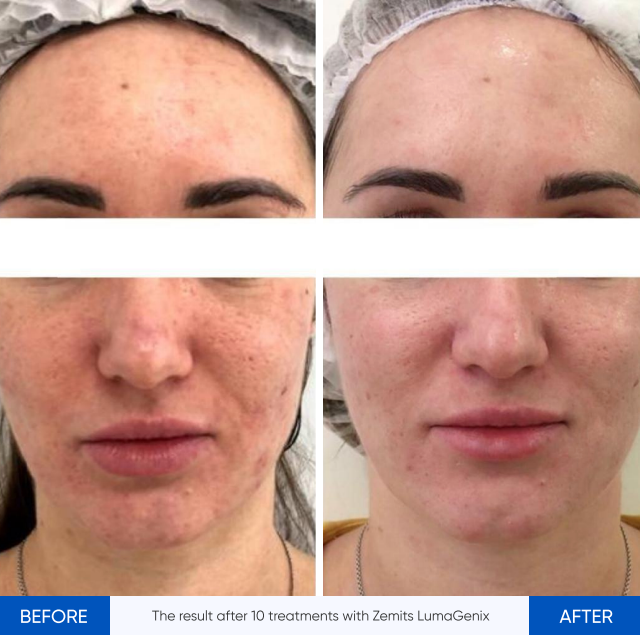 Dispositivo profesional de terapia de luz LED Zemits LumaGenix PDT