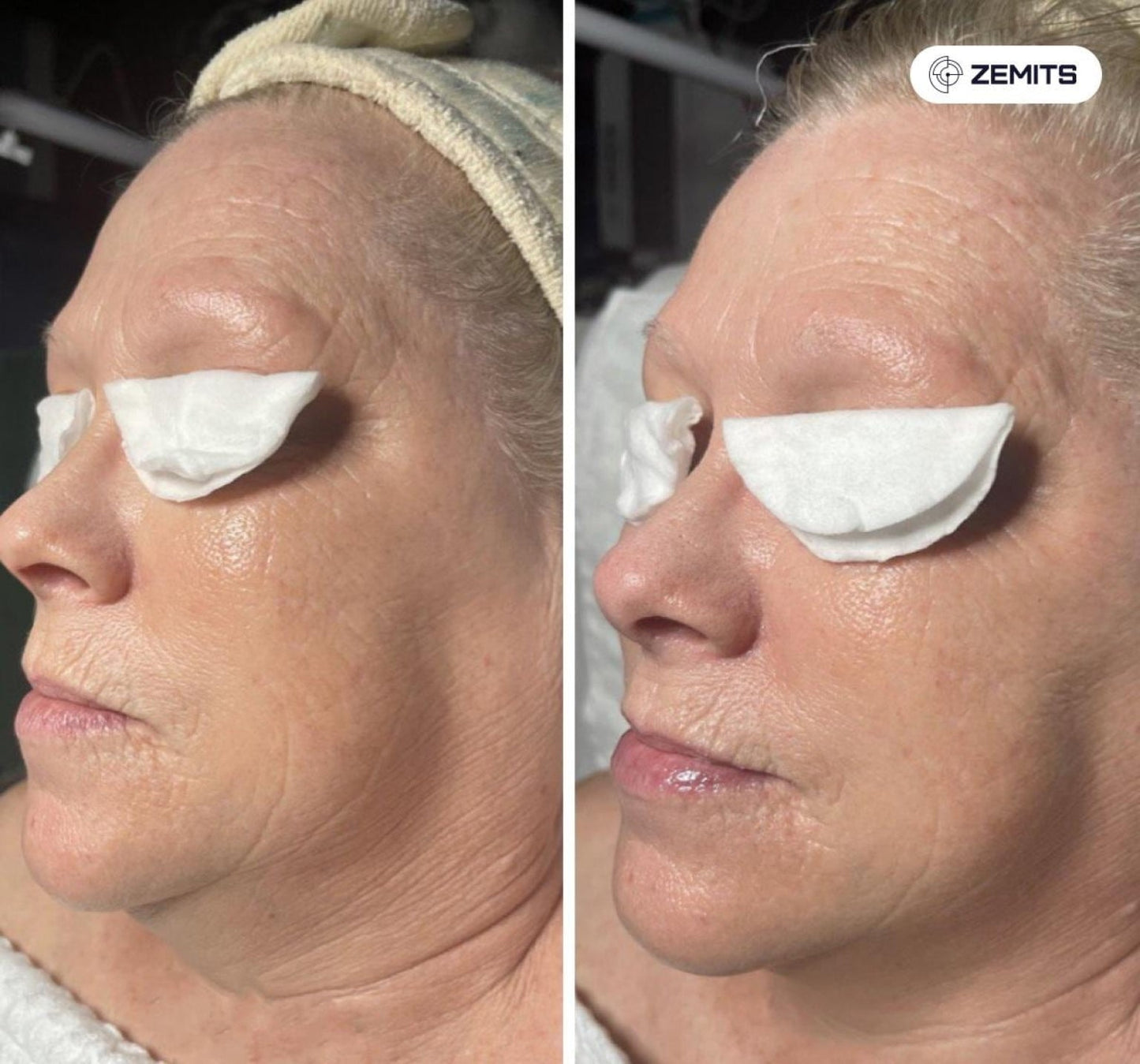 Sistema de Electroporación Zemits Klein EL